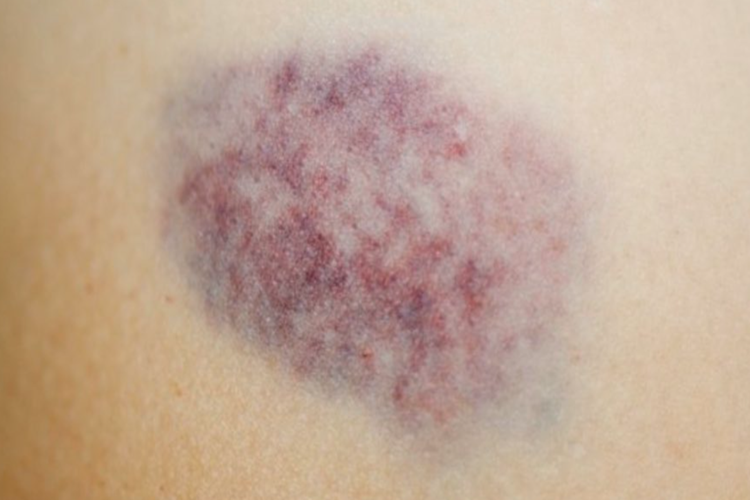 Coraspin Vücutta Morluk Yapar Mı?