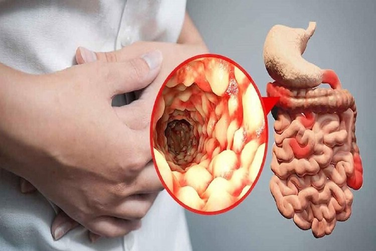 Crohn Hastalığı Belirtileri Nelerdir?