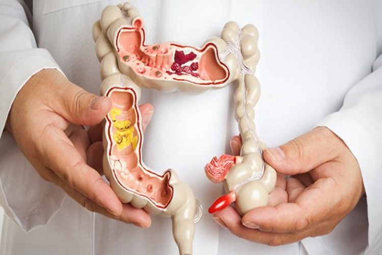 Crohn Hastalığı Engelli Raporu Alabilir Mi?