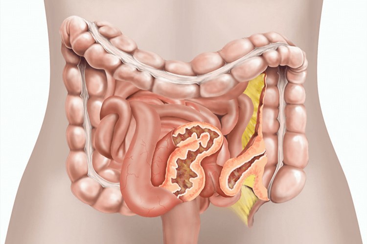 Crohn Hastalığı İyileşir Mi?