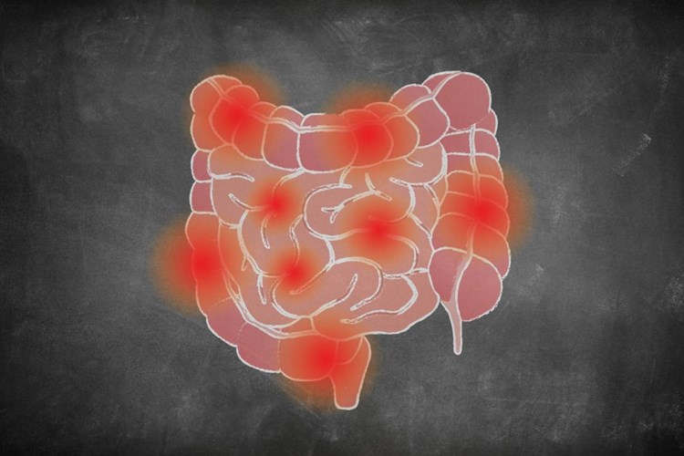 Crohn Hastalığı Tedavi Edilmezse Ne Olur?