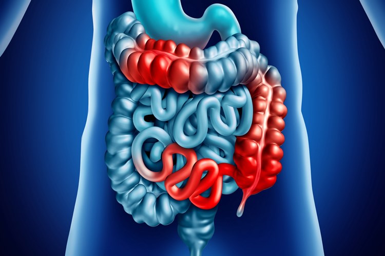 Crohn Hastalığı Tedavisi Nasıldır?