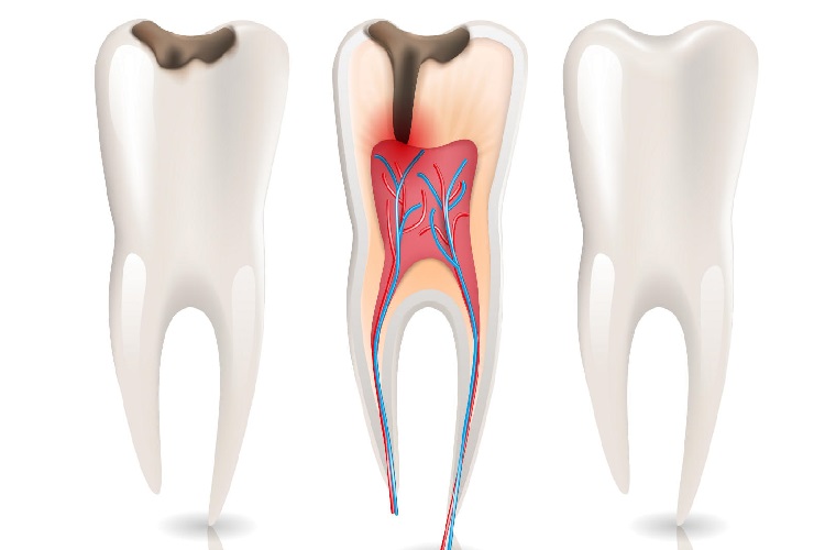 Çürük Diş Nasıl Tedavi Edilir?