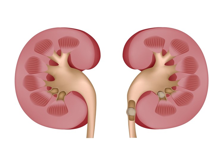 D Vitamini Böbrek Taşı Yapar Mı?