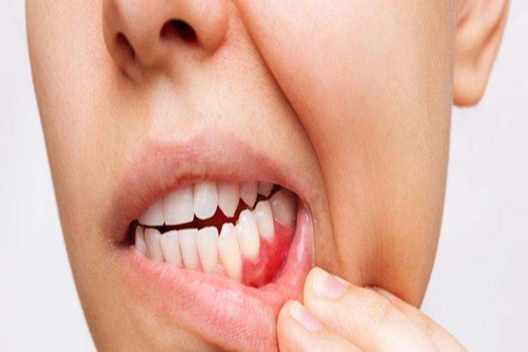 Damak Şişmesi Hangi Vitamin Eksikliğinden Olur?