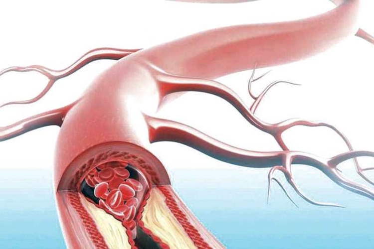 Damar Tıkanıklığı Bitkisel Çözüm Önerileri Nelerdir?