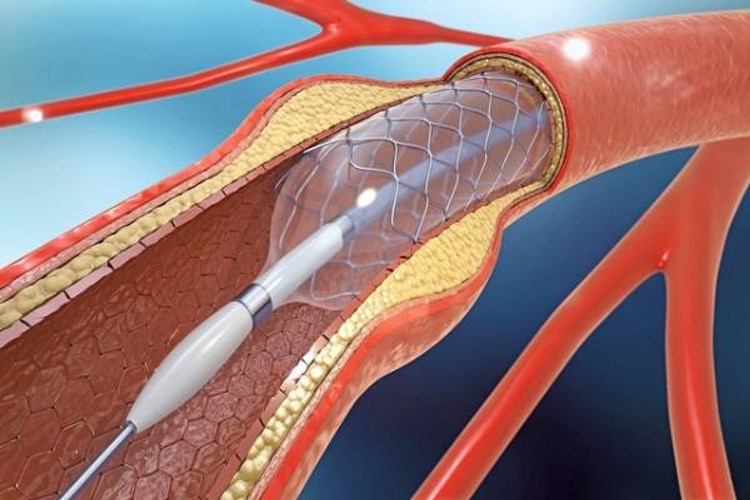 Damara Stent Takıldıktan Sonra Çarpıntı Olur Mu?