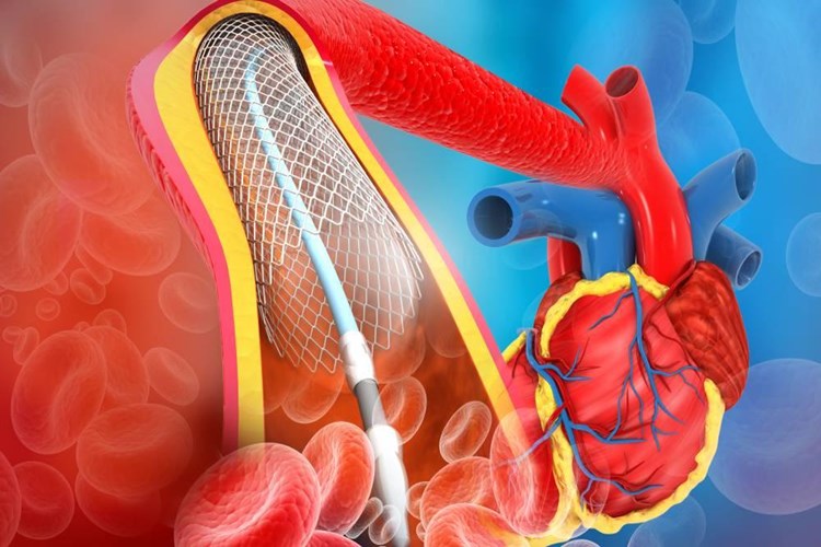 Damara Stent Takıldıktan Sonra Morarma Nasıl Geçer?