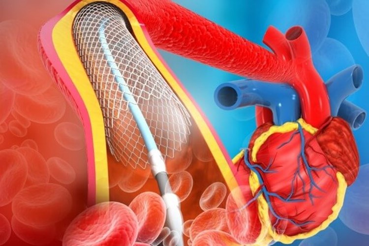 Damara Stent Takıldıktan Sonra Ritim Bozukluğu Neden Olur?