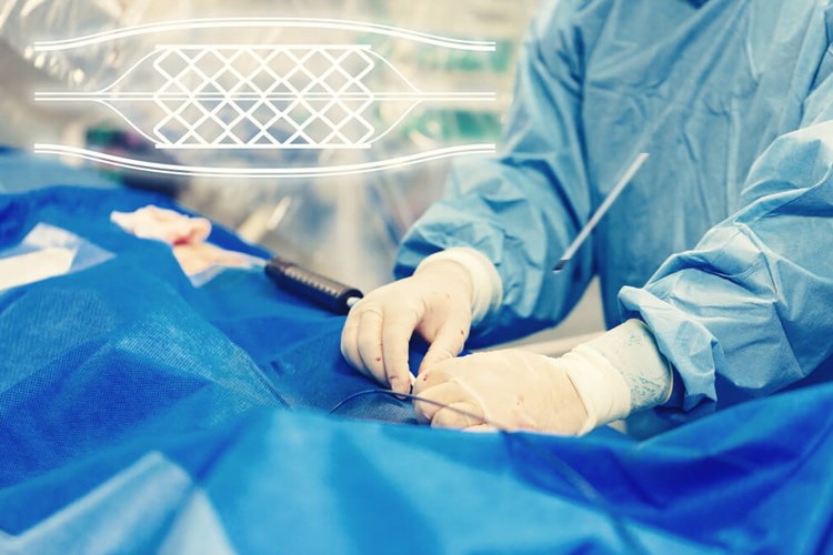 Damara Stent Takıldıktan Sonra Ritim Bozukluğu Olur Mu?