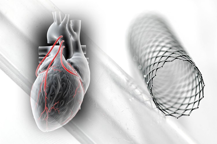 Damara Stent Takıldıktan Sonra Tıkanma Neden Olur?