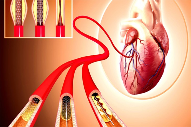 Damara Stent Takıldıktan Sonra Tansiyon Düşüklüğü Olur Mu?