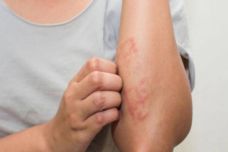 Dermatit Polisliğe Engel Mi?