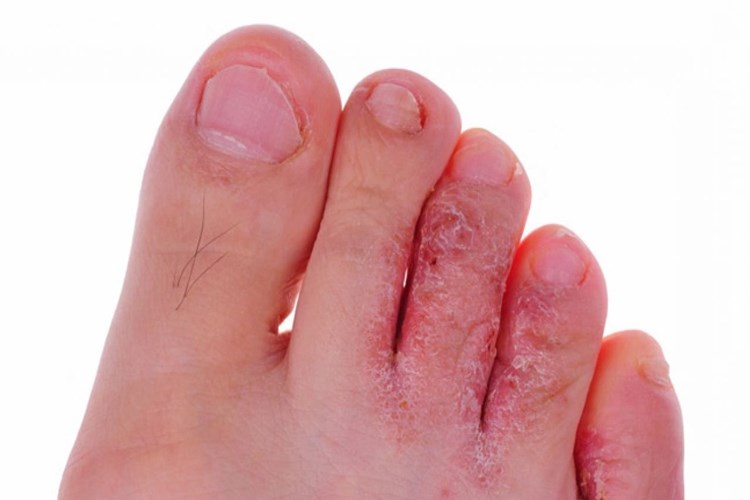 Dermatop Krem Ayak Mantarına İyi Gelir Mi?