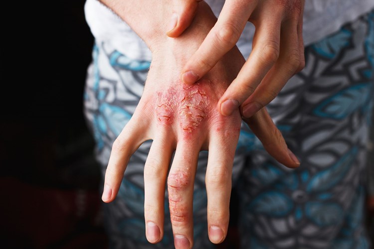 Dermatop Krem Egzamaya İyi Gelir Mi?