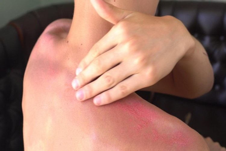Dermatop Krem Güneş Yanığına İyi Gelir Mi?