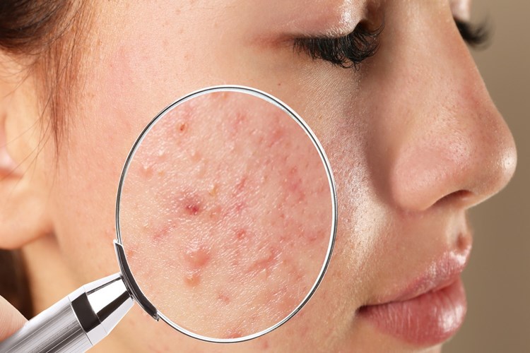 Dermatop Krem Sivilceye İyi Gelir Mi?