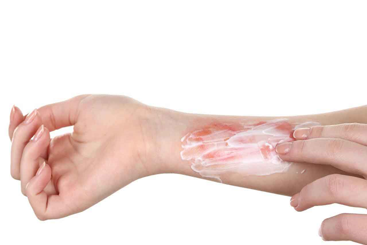 Dermatop Yanığa İyi Gelir Mi?