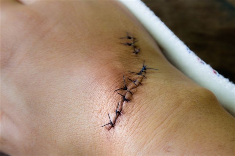 Dikişli Hasta Uçağa Binebilir Mi?