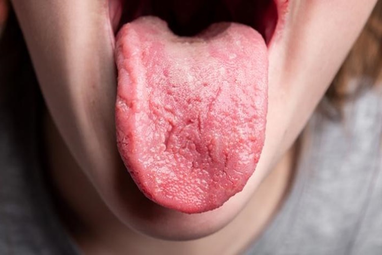 Dil Çatlakları Hangi Vitamin Eksikliğinden Olur?