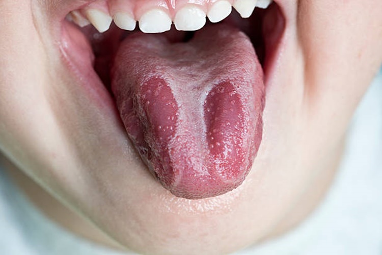 Dilde Mantar Çıkar Mı?