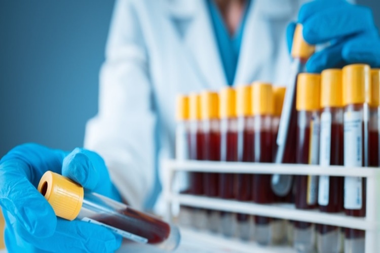 Dimer Testi Neden Yapılır?