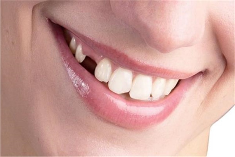 Diş Düşmesi Orucu Bozar Mı?
