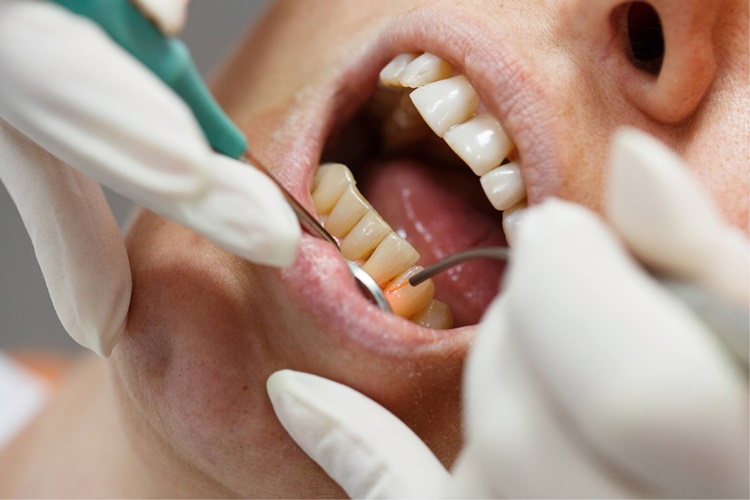 Diş Eti Çekilmesi Hakkında Bilinmesi Gerekenler