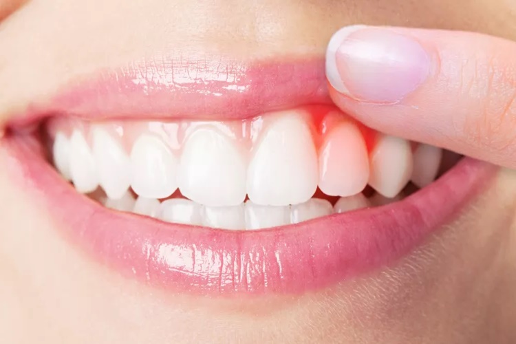 Diş Eti Çekilmesi Hangi Vitamin Eksikliğinden Olur?