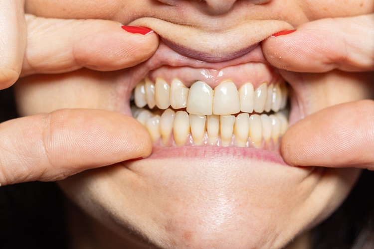 Diş Eti Çekilmesi Nasıl Önlenir?