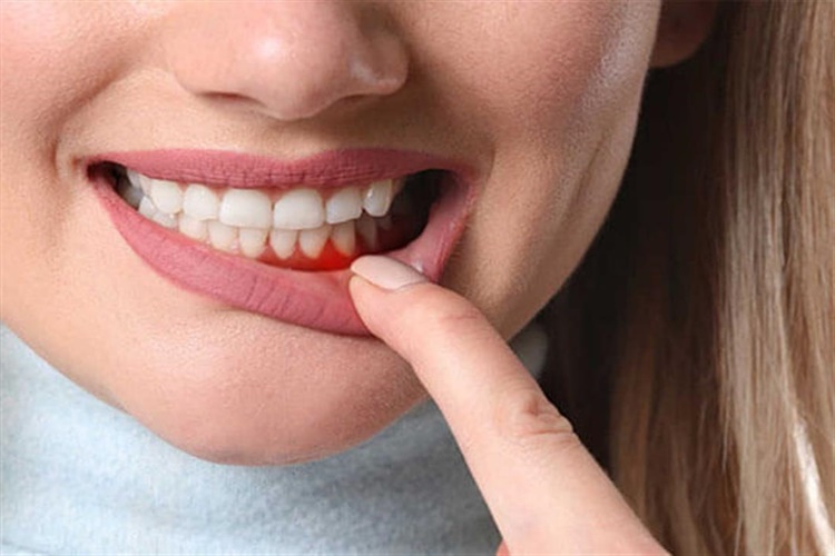 Diş Eti İltihabı Hangi Vitamin Eksikliğinden Olur?