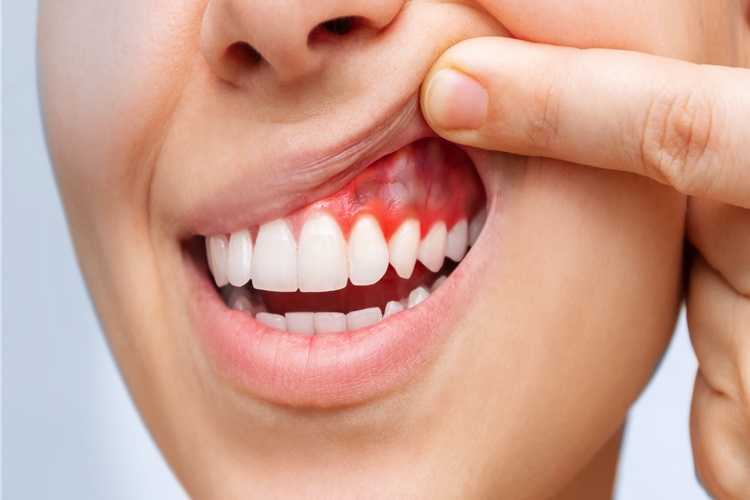 Diş İltihabı Göze Zarar Verir Mi?
