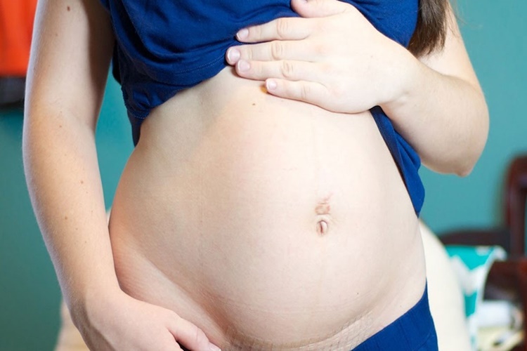 Doğumdan Sonra Şişkinlik Ne Zaman Geçer?