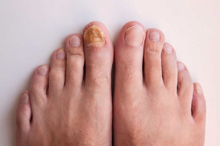 Dolama Nasıl Tedavi Edilir?