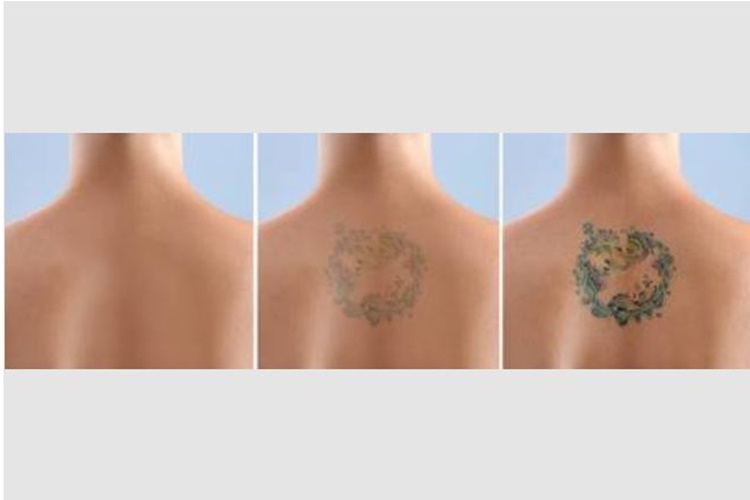 Dövme Tamamen Silinir Mi?