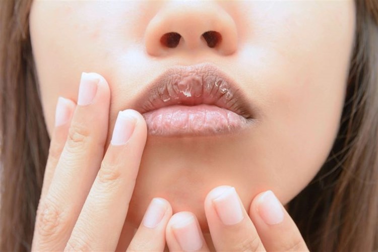 Dudak Çatlaması Hangi Vitamin Fazlalığından Olur?