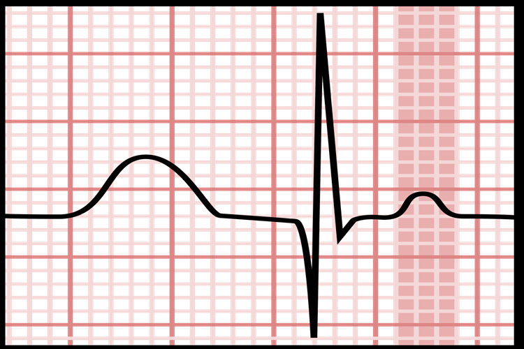 Ekg'de P Dalgası Neyi Gösterir?
