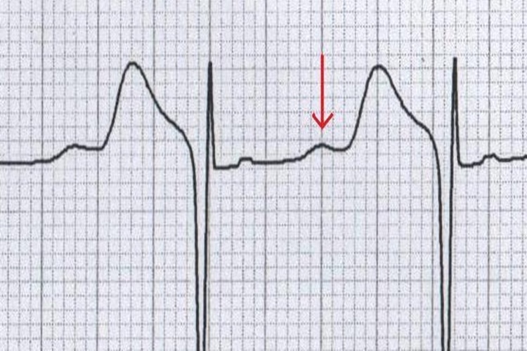 Ekg De Qrs Dalgası Neyi Gösterir?