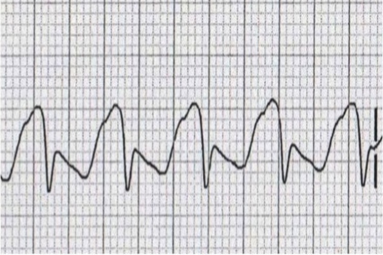 Ekg De R Dalgası Neyi Gösterir?