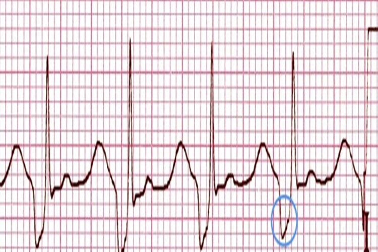 Ekg De S Dalgası Neyi Gösterir?