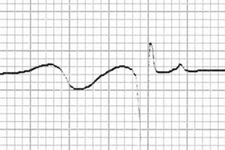 Ekg De T Dalgası Neyi Gösterir?
