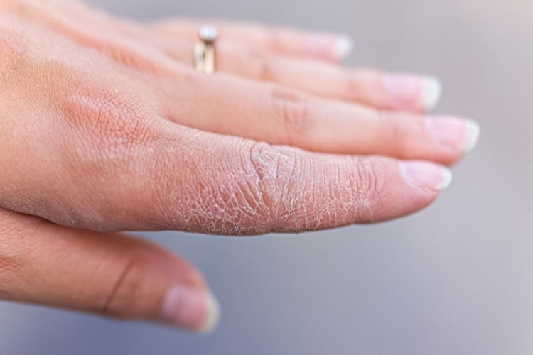El Kuruluğu Hangi Vitamin Eksikliğinden Olur?