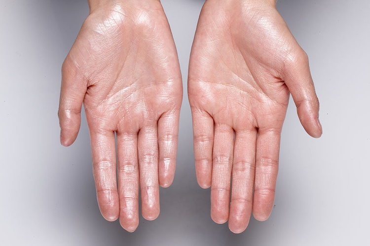 El Terlemesi Hangi Vitamin Eksikliğinden Olur?