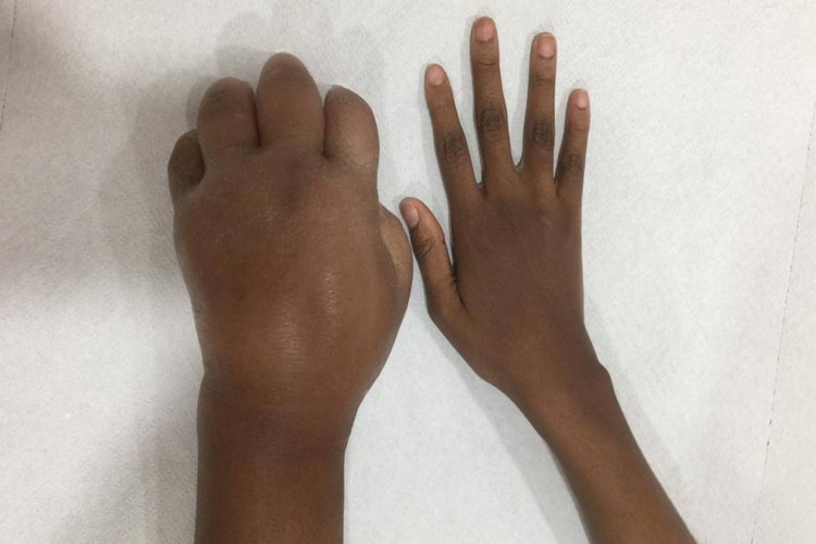 El Üstü Neden Şişer?