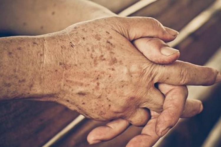 El Üstünde Çillenme Neden Olur?