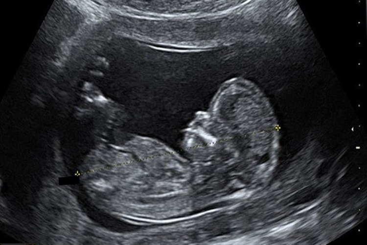 En Erken Cinsiyet Ne Zaman Belli Olur?