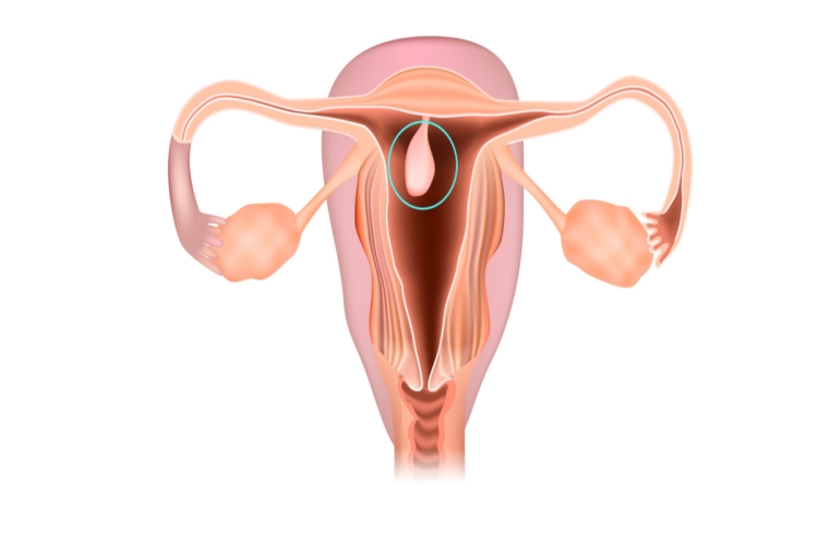 Endometriozis Genetik Midir?