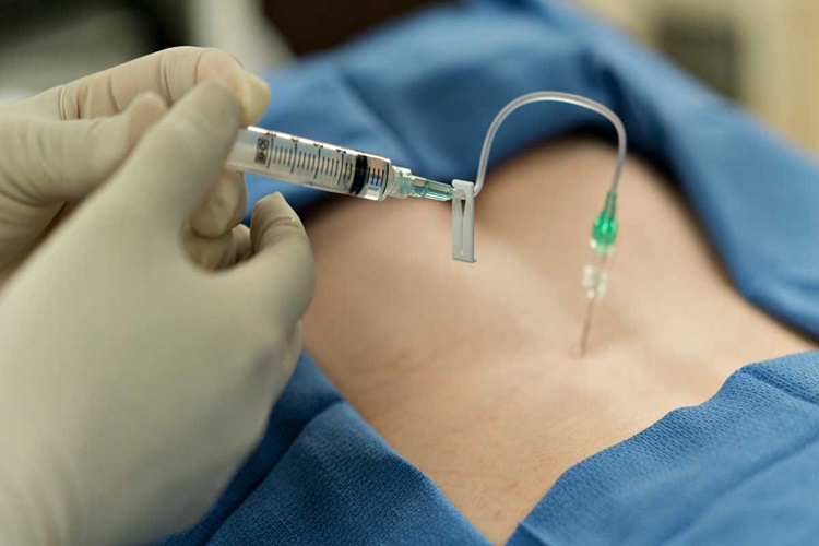 Epidural Devlet Karşılıyor Mu?