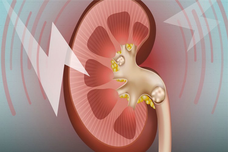 Et Böbrek Taşı Yapar Mı?