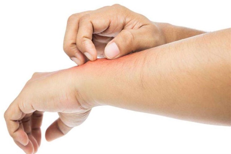 Expigment Kaşıntı Yapar Mı?